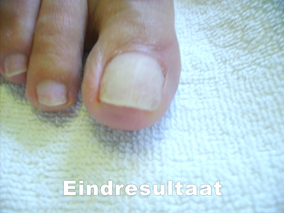 Nagelreparaties en nagelprotheses Pedicure Mieke