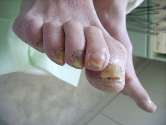 Diabetische voet Pedicure Mieke
