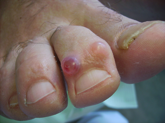 Reumatische voet Pedicure Mieke